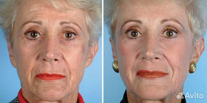 Модели на Алмазный Пилинг (бесплатно)