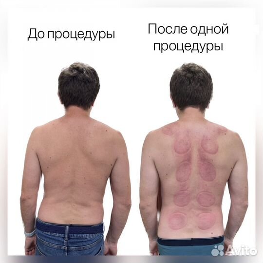 Лечение позвоночника.Массаж Гуаша