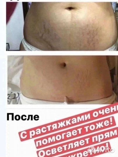 Антицеллюлитный гель