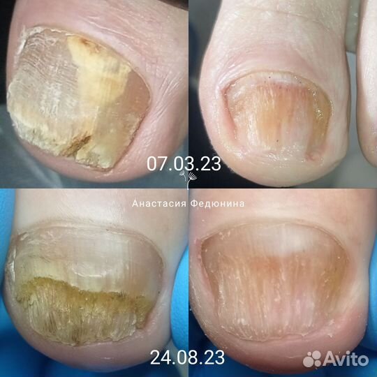 Подолог, Педикюр, SMART, Медицинский педикюр