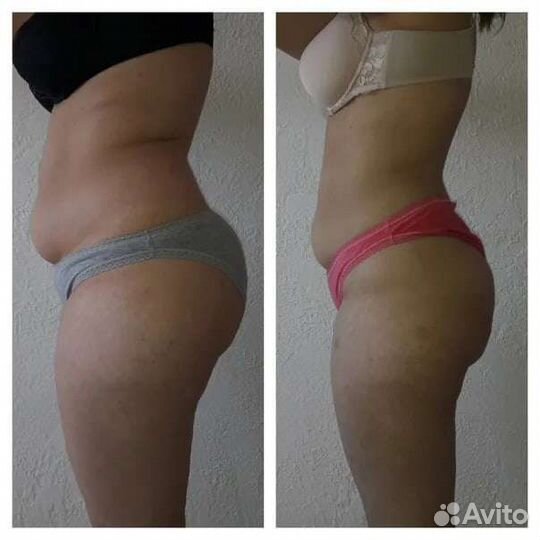 Антицеллюлитный массаж