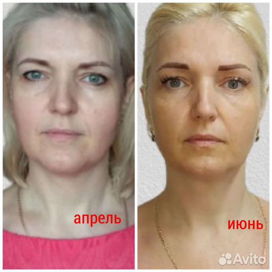 Омоложение лица и шеи Витапластика Массаж лица