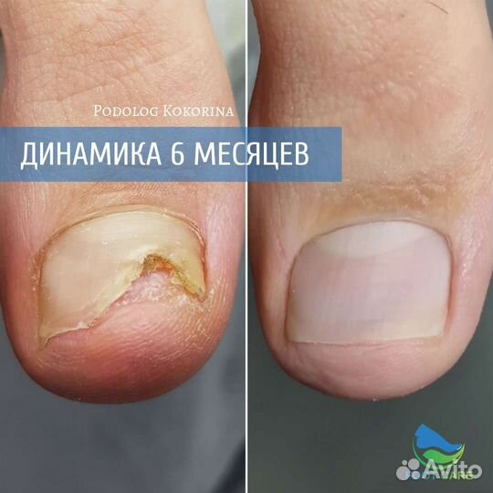 Подолог. Вросший ноготь / медицинский педикюр