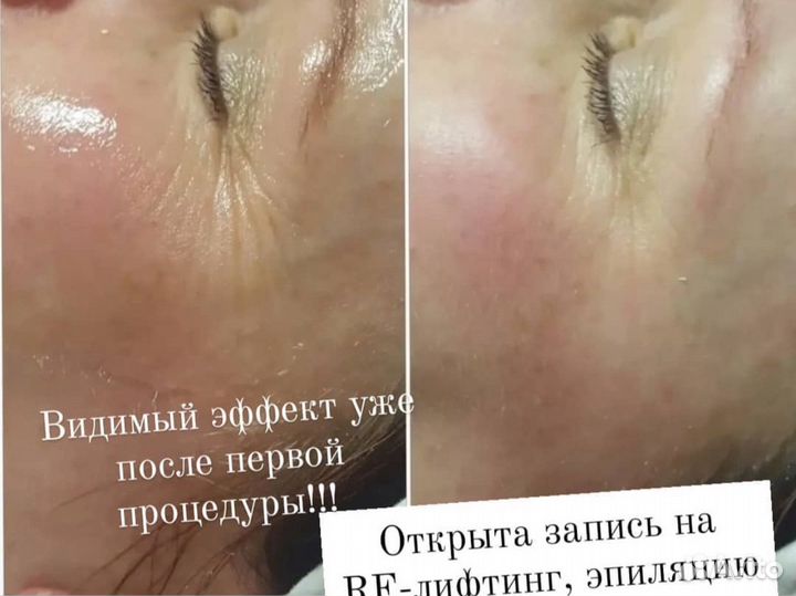 Лазерная эпиляция,фотоомоложение,rf лифтинг