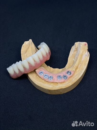 All on 4 протез, изготовление