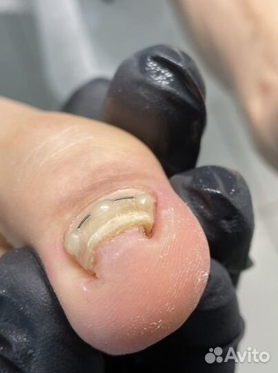 Установка коррекционной ситемы титановая нить