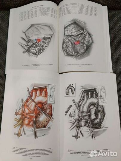 Атлас грудной хирургии. 2 тома. Петровский Б.В