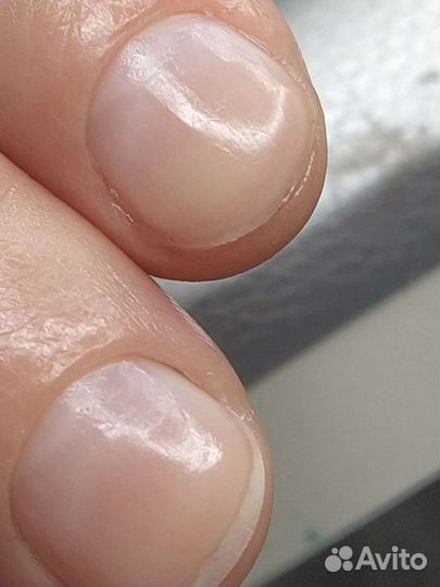 Педикюр маникюр вросший ноготь