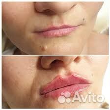 Косметолог Чистка лица, уколы красоты