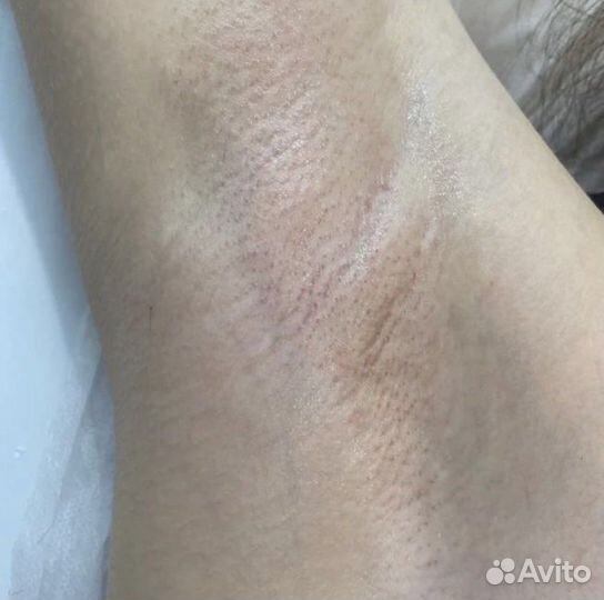 Электроэпиляция Apilus
