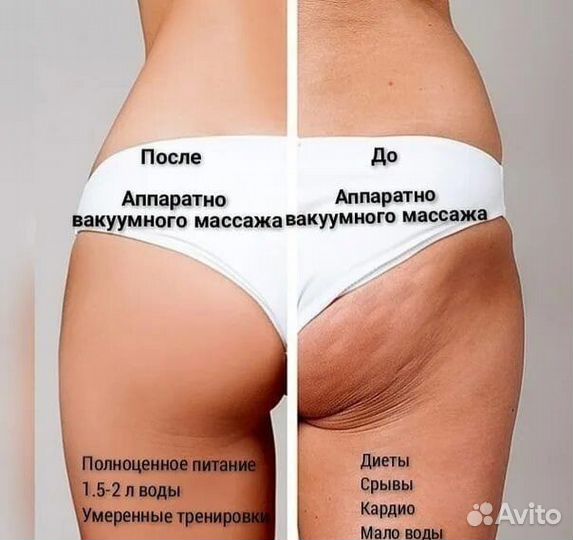 Вакуумный массаж аппаратный