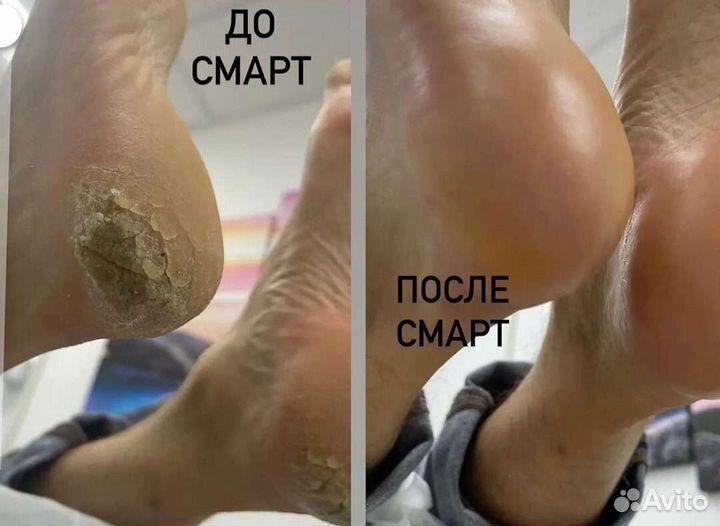 Педикюр