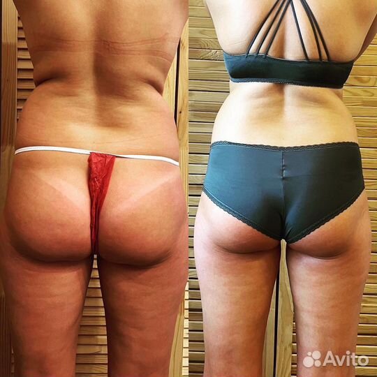 Массаж для похудения. Антицеллюлитный массаж.Налар